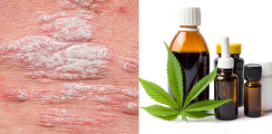 Is CBD The Future of Psoriasis and Eczema Cure?